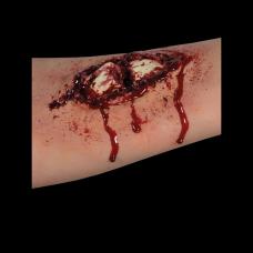prothese latex fracture ouverte du bras